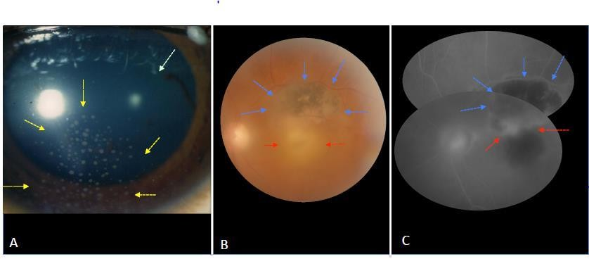 Ophtalmologic, serologic and therapeutic aspects of ocular toxoplasmosis toxoplasmose oculaire: aspects ophtalmologiques, sérologiques et thérapeutiques