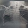 Case- Report of Tuberculosis in a Tanzanian Male Sickle Cell Disease Patient
